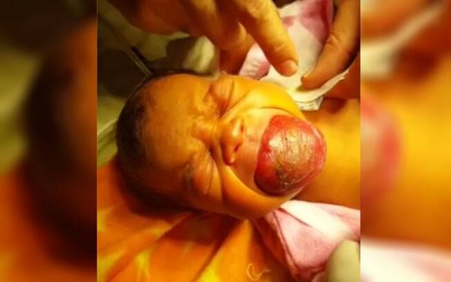 Problema só foi descoberto após o parto, e os médicos alertaram aos pais que o bebê poderia não resistir 