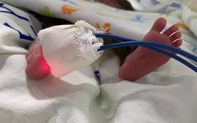 Brasil tem 'legião de bebês prematuros' com alta de covid em grávidas
