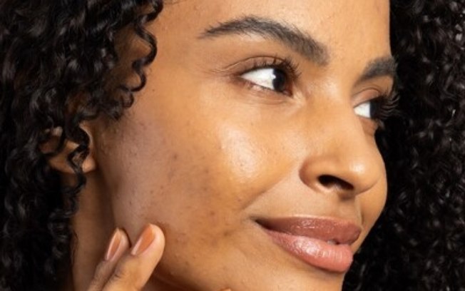 Glitter, maquiagem e calor: como evitar acne e irritações na pele durante o Carnaval