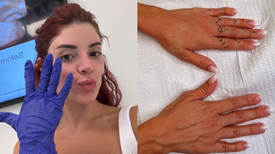 Gkay realizou procedimento estético com médico das Kardashians Gkay realizou procedimento estético com médico das Kardashians