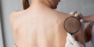 Pintas e sinais no corpo: afinal, quando é preciso se preocupar?