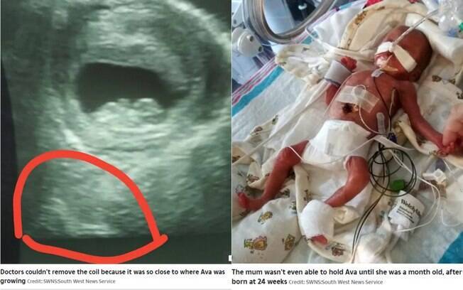 Evelynn estava usando DIU quando ficou grávida de Ava e a menina nasceu com o dispositivo sob a axila