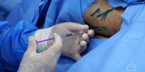 Avanço da polilaminina mira caminho inédito contra a paraplegia