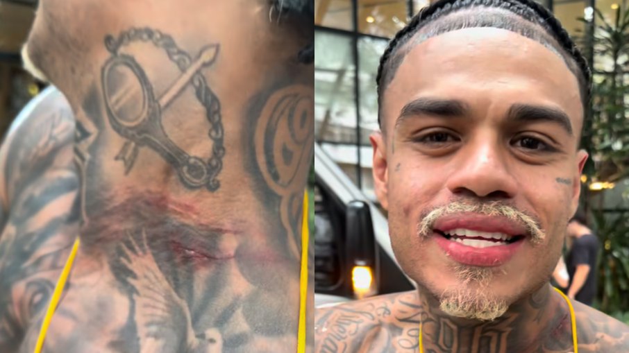 MC Cabelinho mostra ferimento no pescoço MC Cabelinho mostra ferimento no pescoço