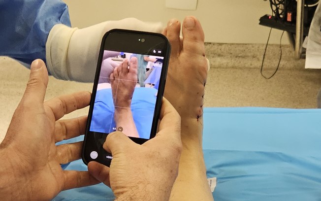 Tratamento das joanetes avança com cirurgia pouco invasiva