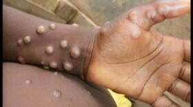 Cientistas acham 50 variações no vírus da varíola