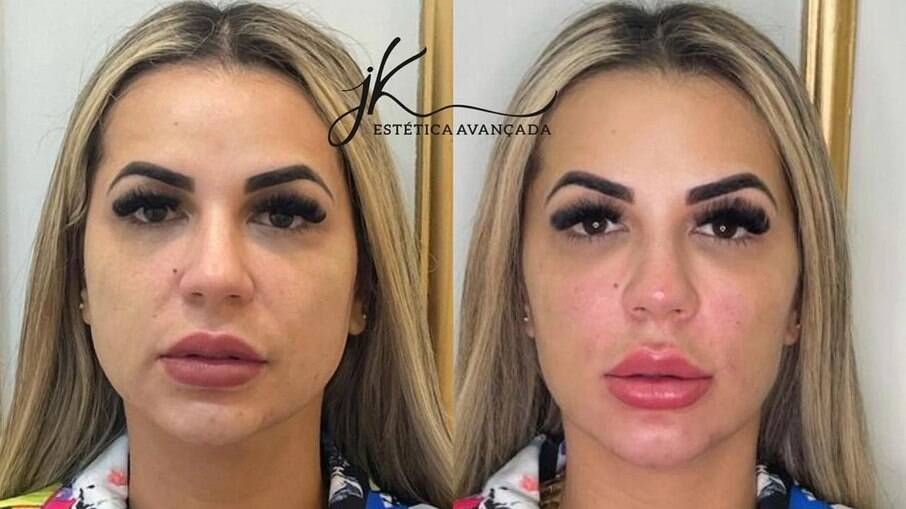 Antes e depois da harmonização facial de Deolane Bezerra