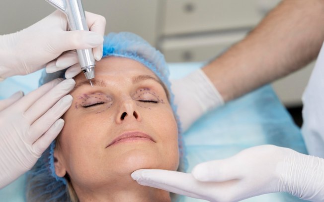 Blefaroplastia remodela pálpebras e rejuvenesce o olhar