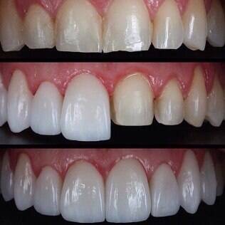 Lentes de contato dental: fotos de boca antes, durante e depois do procedimento estético