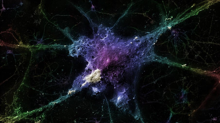 Este neurônio está sob o efeito da proteína beta-amilóide. A proteína gera as placas de senilidade, que, acredita-se, seriam as principais causas do Alzheimer