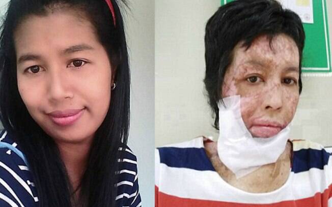Tailandesa foi ateada em chamas por marido abusivo em surto de ciúmes provocado por selfies no Facebook