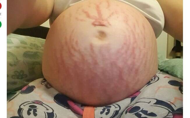 De acordo com os médicos, era como se o corpo da grávida estivesse rejeitando o bebê 