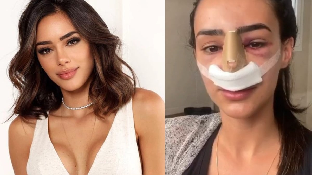 Antes e depois da cirurgia de Bruna Biancardi viraliza na web; veja