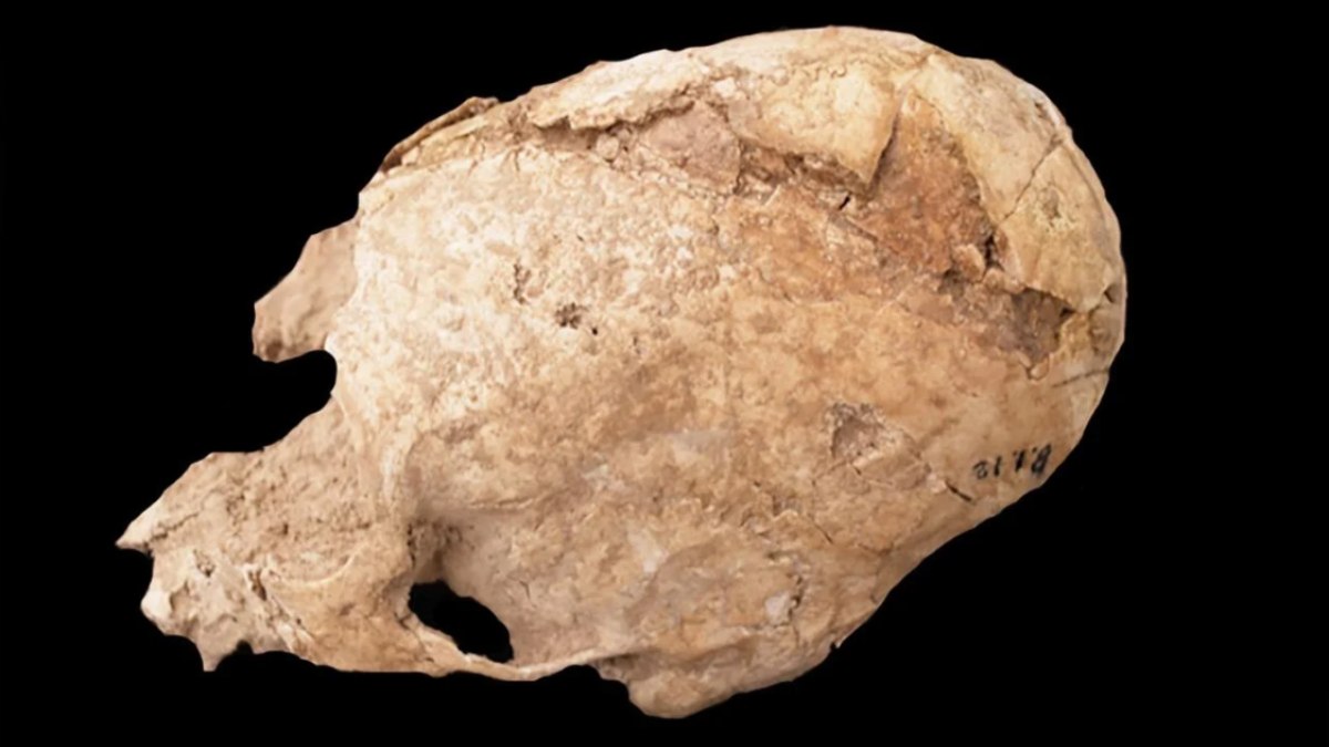 Crânio de uma jovem apresentando sinais de deformação craniana e ferimento fatal