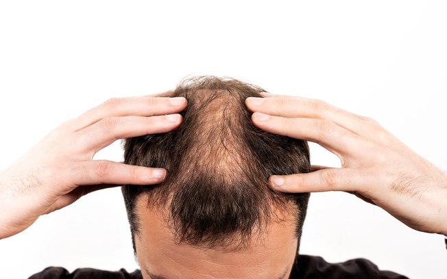 Alopecia: técnicas de tricologia podem oferecer soluções