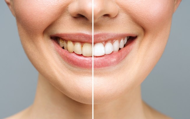 Cúrcuma ajuda a clarear os dentes? Especialista explica as vantagens e riscos da técnica