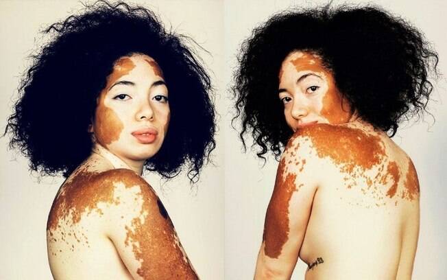 O fotógrafo britânico Brock Elbank convidou pessoas com vitiligo para participarem como modelos de uma série de fotos 