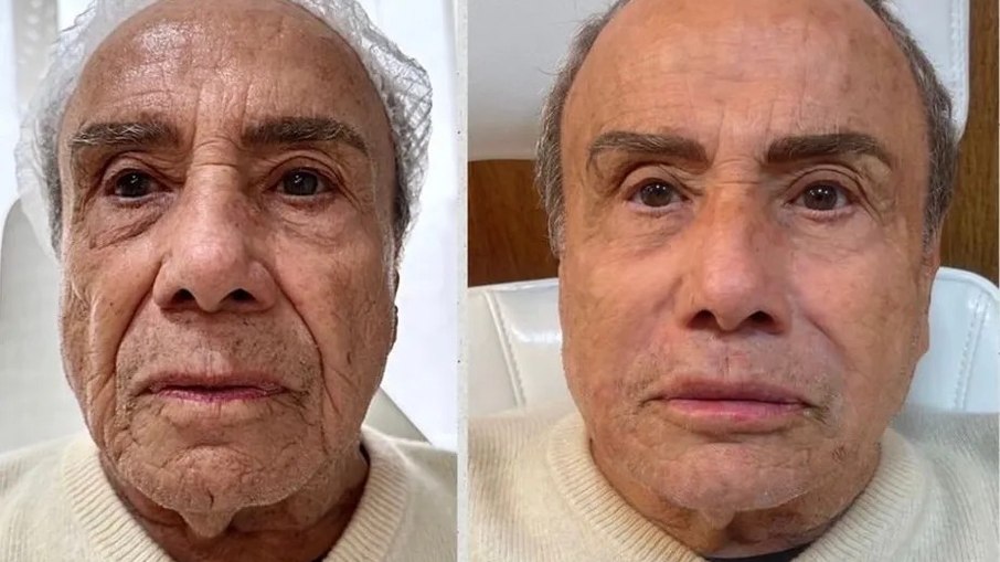 Stênio Garcia revela o antes e o depois da harmonização facial