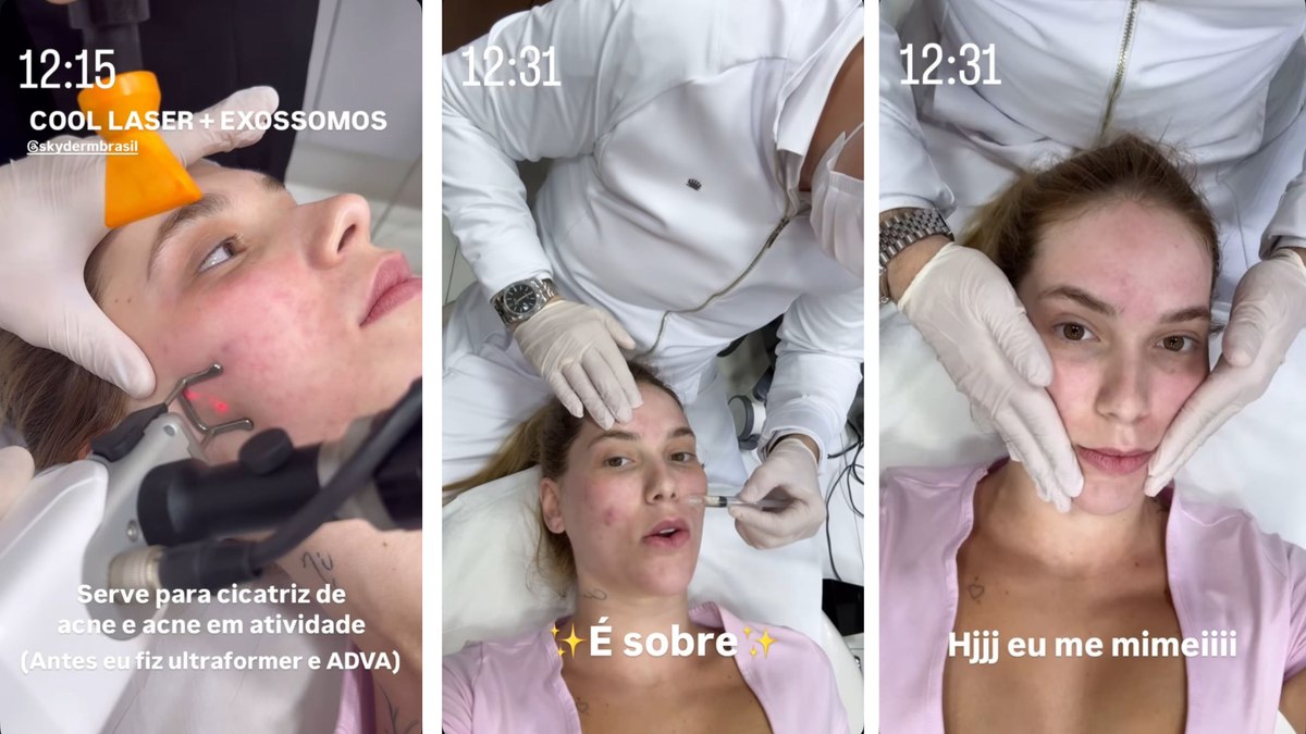 Virginia Fonseca aposta em tratamento inovador com esperma de salmão para combater acne