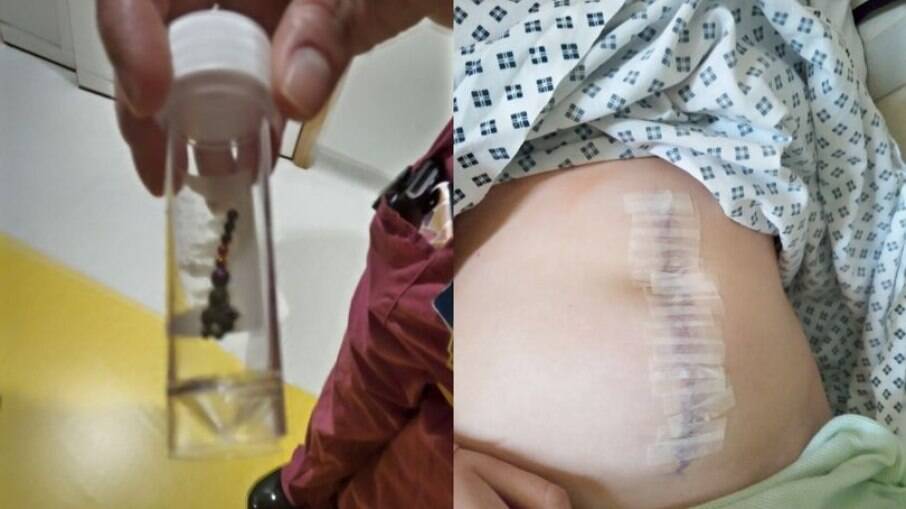 Menina de 13 anos passou por cirurgia de 6 horas depois de engolir esferas magnéticas