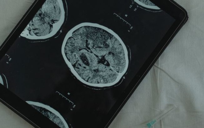 Microimplante cerebral pode tratar distúrbios neurológicos