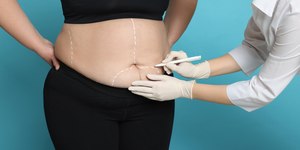 O que considerar antes de fazer cirurgia plástica na menopausa