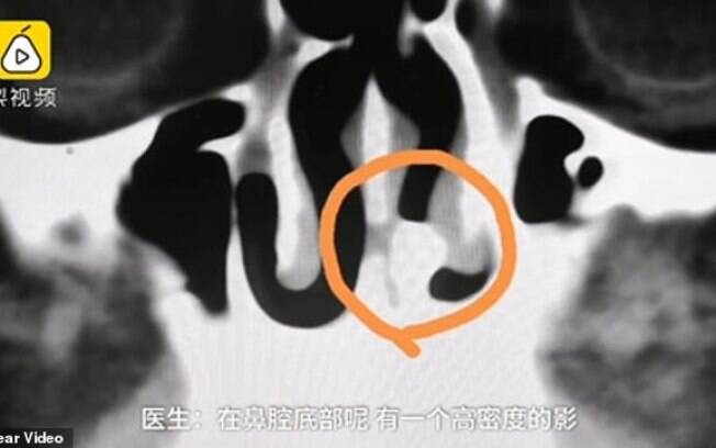 Dente se enraizou no nariz após cair em um incidente na infância. Paciente chinês disse que não sentia desconforto por duas décadas.