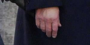 Maquiagem na mão de Trump levanta suspeita sobre sua saúde