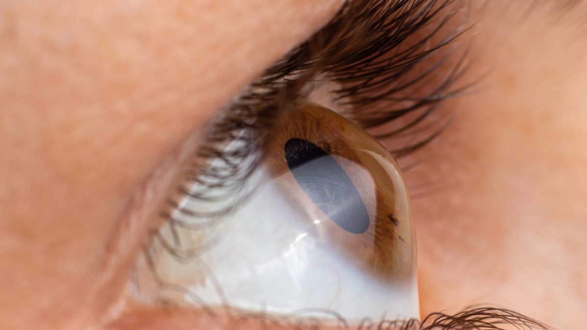 Ceratocone Ceratocone