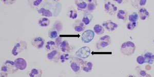 Homem morre após infecção rara por ameba no cérebro