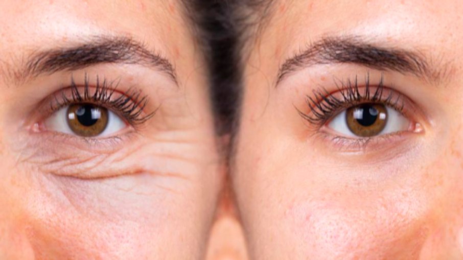 Mitos e verdades sobre a blefaroplastia