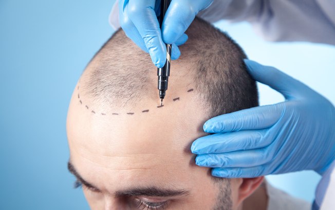 Técnica FUE otimiza resultados do transplante capilar Técnica FUE otimiza resultados do transplante capilar