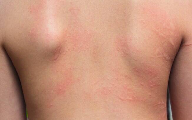 Além disso, o chikungunya pode fazer com que o fígado fique inchado, apareçam ínguas e erupções na pele. Foto: iStock