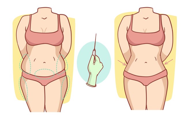 Lipoaspiração é a cirurgia plástica mais realizada no Brasil Lipoaspiração é a cirurgia plástica mais realizada no Brasil