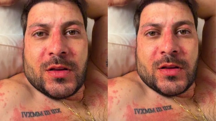 Ex-BBB Caio Afiune é internado após crise alérgica