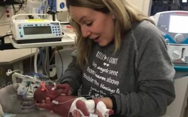 Prematuras, as irmãs gêmeas nasceram na 22ª semana de gestação e surpreenderam pelo tamanho pequeno 