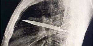 Em consulta, homem descobre faca alojada no peito há oito anos