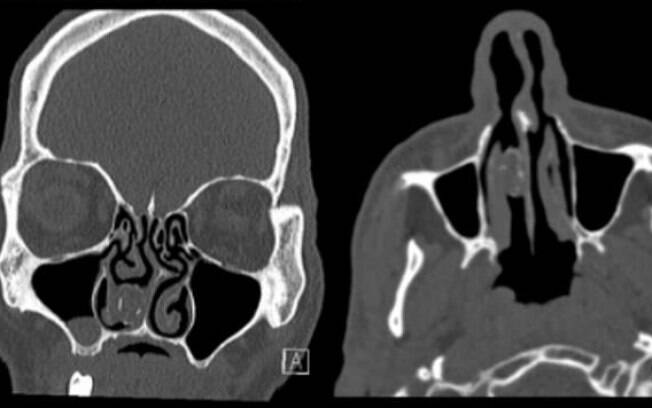 Ressonância magnética detectou maconha escondida no nariz de homem