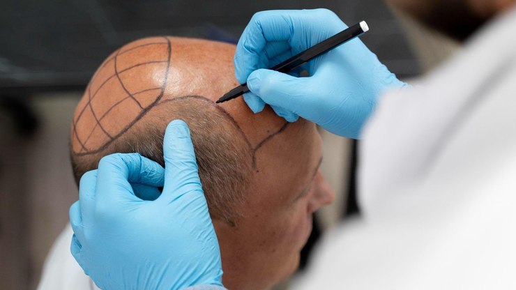 Transplante ou implante: quando fazer um ou outro e quanto custa