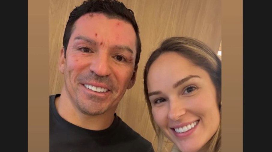 Lúcio mostra o rosto pela primeira vez após sofrer queimaduras