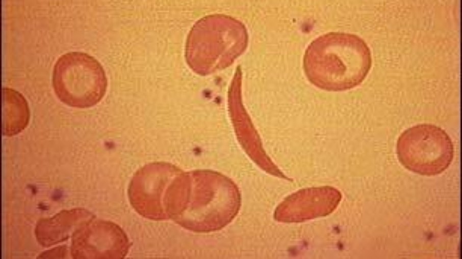 Glóbulos vermelhos, células falciformes