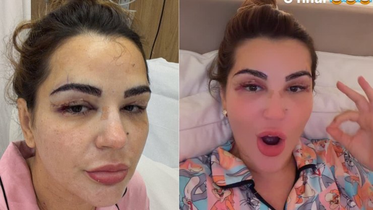 Deolane surge com hematomas no rosto e assusta web