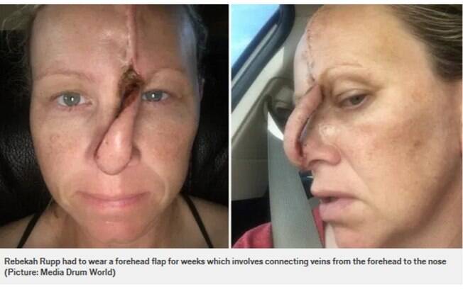 Mulher que era viciada em bronzeamento artificial por anos desenvolveu câncer de pele e teve um buraco no nariz