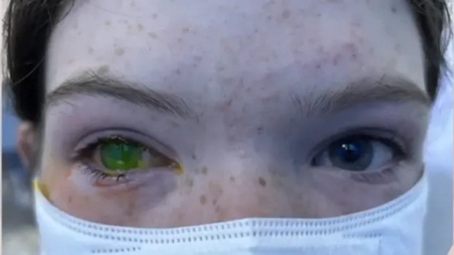 Doença causada por besouro muda cor dos olhos e provoca dor extrema, alertam australianos