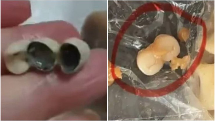 Clientes acham dentes humanos em alimentos 3 vezes em uma semana