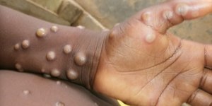 Porto Alegre confirma primeiro caso de Mpox em 2026