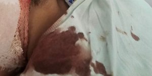 Menino tem orelha arrancada em ataque de cão no interior de SP