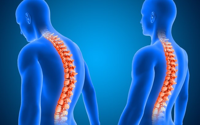 Cirurgia de escoliose é a 1ª com neuronavegação em Uberlândia Cirurgia de escoliose é a 1ª com neuronavegação em Uberlândia