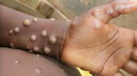 Jovem de 26 anos é 1º brasileiro infectado por varíola dos macacos