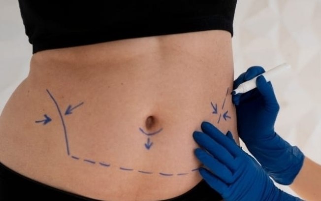 Mini ou abdominoplastia: especialista aponta melhor escolha